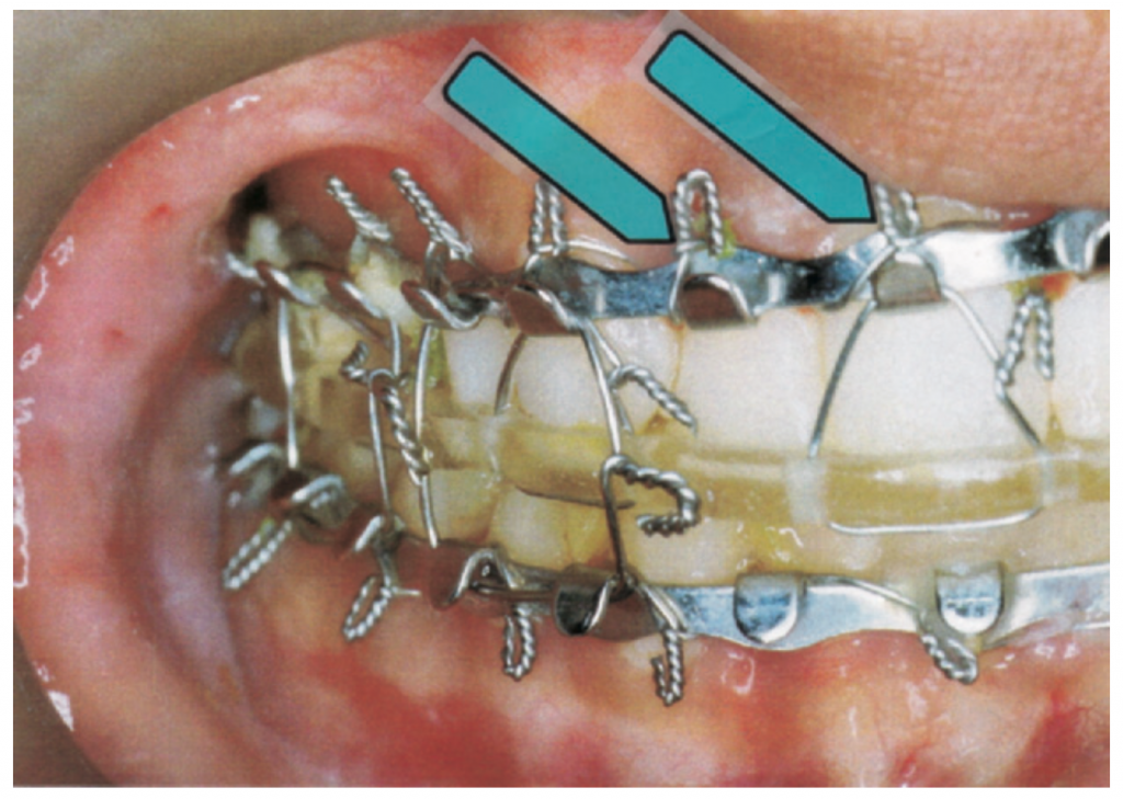 broken-jaw-wired-shut-procedure